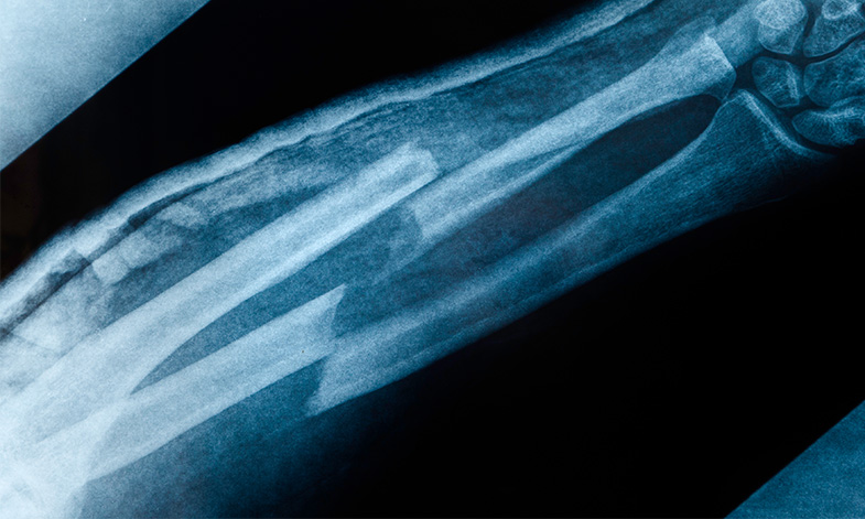 Image of an arm fracture xray.