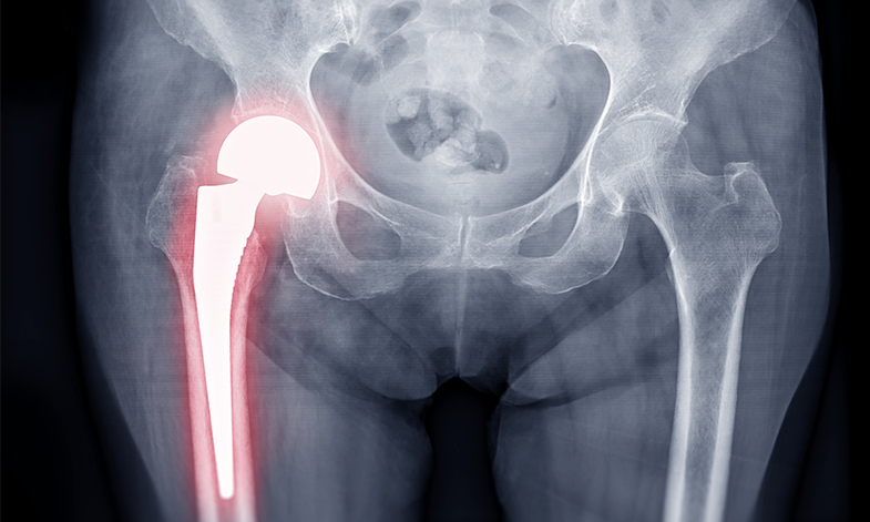 Cerclage Wire Hip Replacement thumbnail