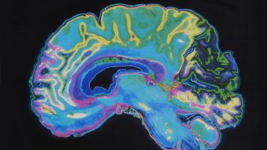 MRI image of brain