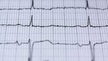 A photograph of an electrocardiogram showing a normal heart rate.