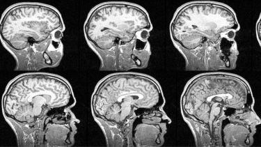 Brain MRI image