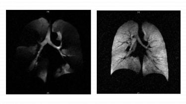 These two 3He images show a clear difference between the two set of lungs and the ventilation defects can be clearly seen in the COPD patient’s lungs.