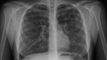 cystic fibrosis