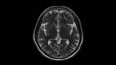 Brain MRI Scan of Healthy Male ( Magnetic Resonance Imaging)