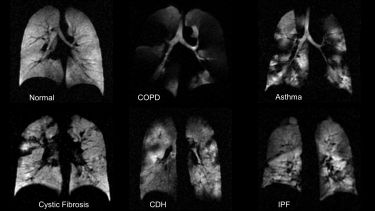 Hyperpolarised gas ventilation images from different patients