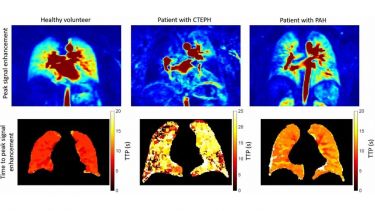 Dynamic contrast enhanced perfusion images
