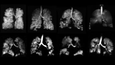 Hyperpolarised gas ventilation images in COPD and asthma