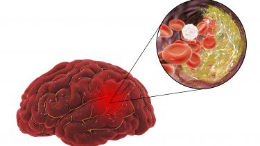 atherosclerosis in brain