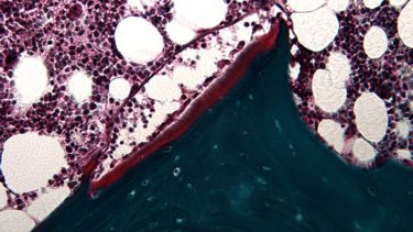 Goldner's trichrome of Human bone biopsy