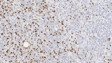 Ki-67 - Immunohistochemistry