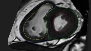 MRI of a human heart
