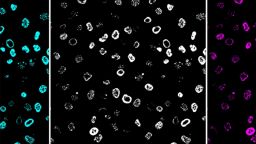 RINGs of DNA damage in human cells caused by the typhoid toxin underlying typhoid fever