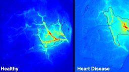 Vascular dementia