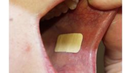 Oromucosal drug delivery