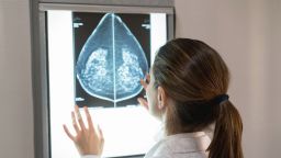 female gynocologist looking at a mammogram